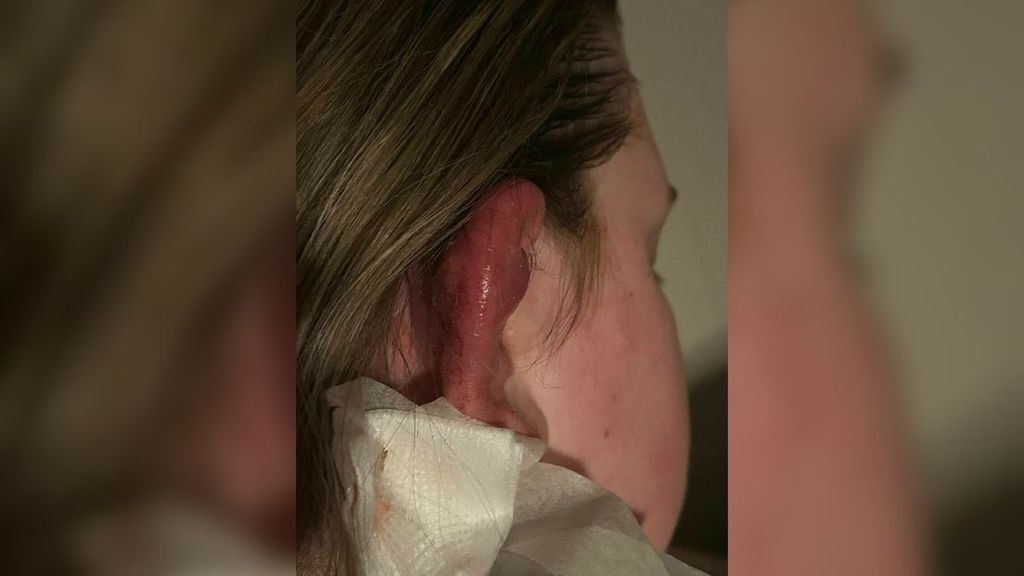 Meer dan 150 klachten over besmette piercingspray uit Coevorden